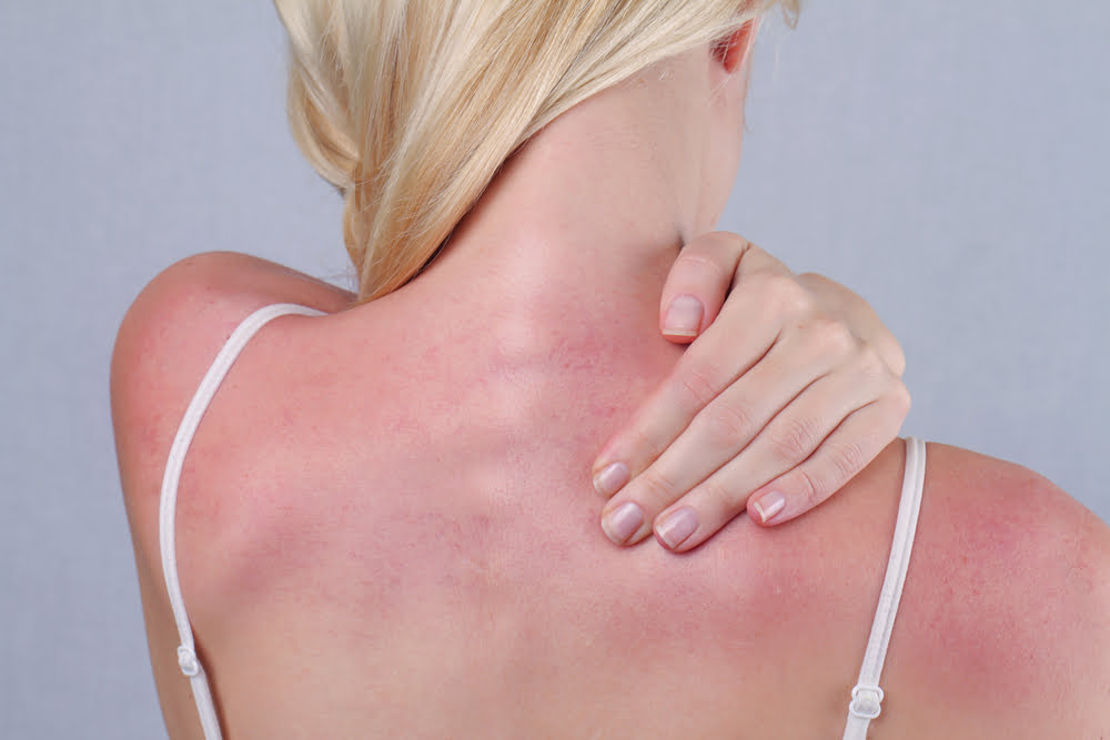 Red Light Therapy for Sun Damaged Skin