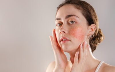 Red Light Therapy for Rosacea