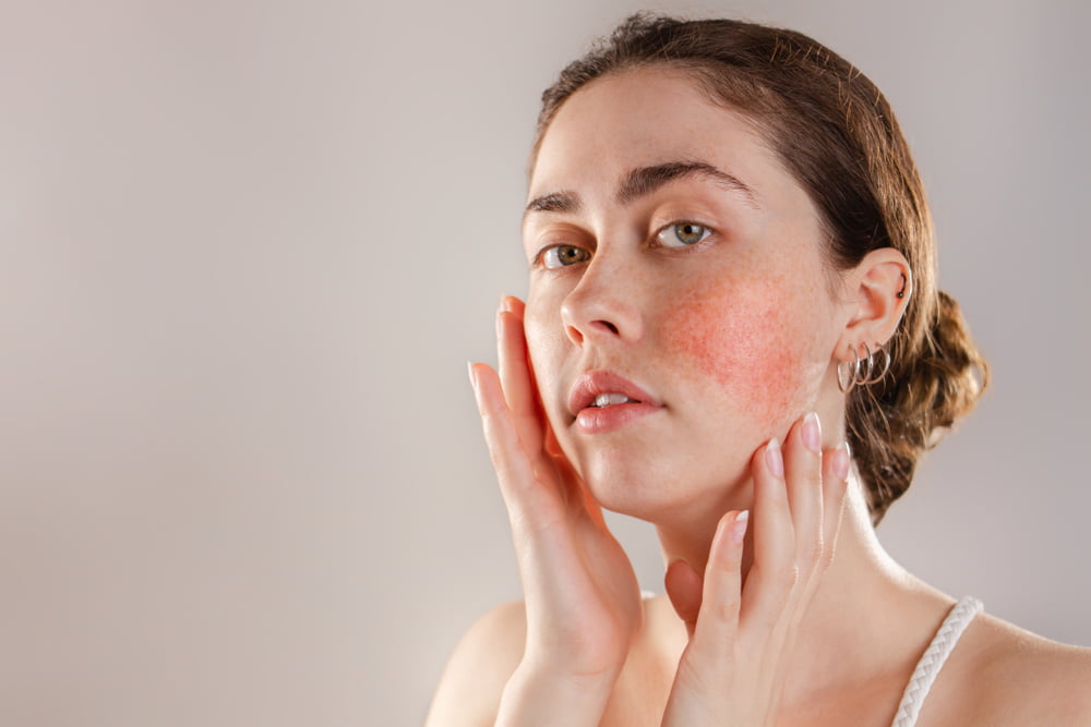 Red Light Therapy for Rosacea Spectra Red Light