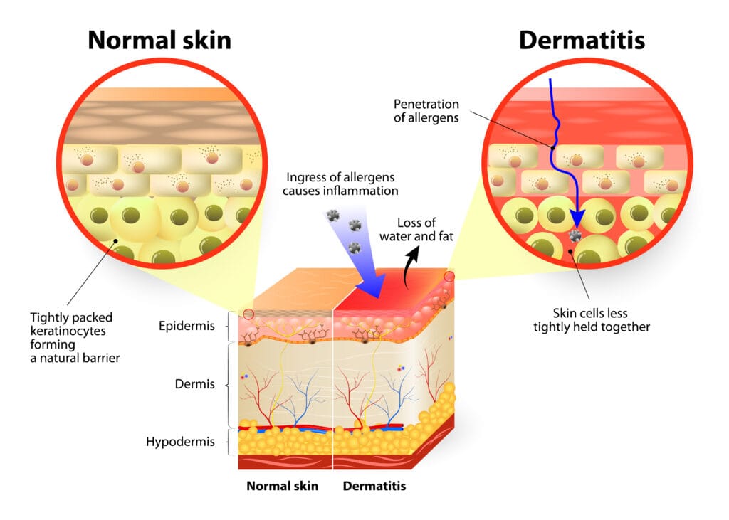 Eczema Process
